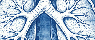 支气管扩张严重吗？有哪些症状？